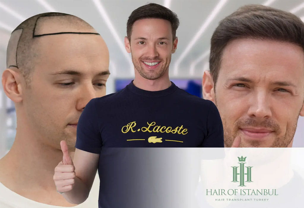 Hair Transplant in Turkey 3 turkey hair transplant cost