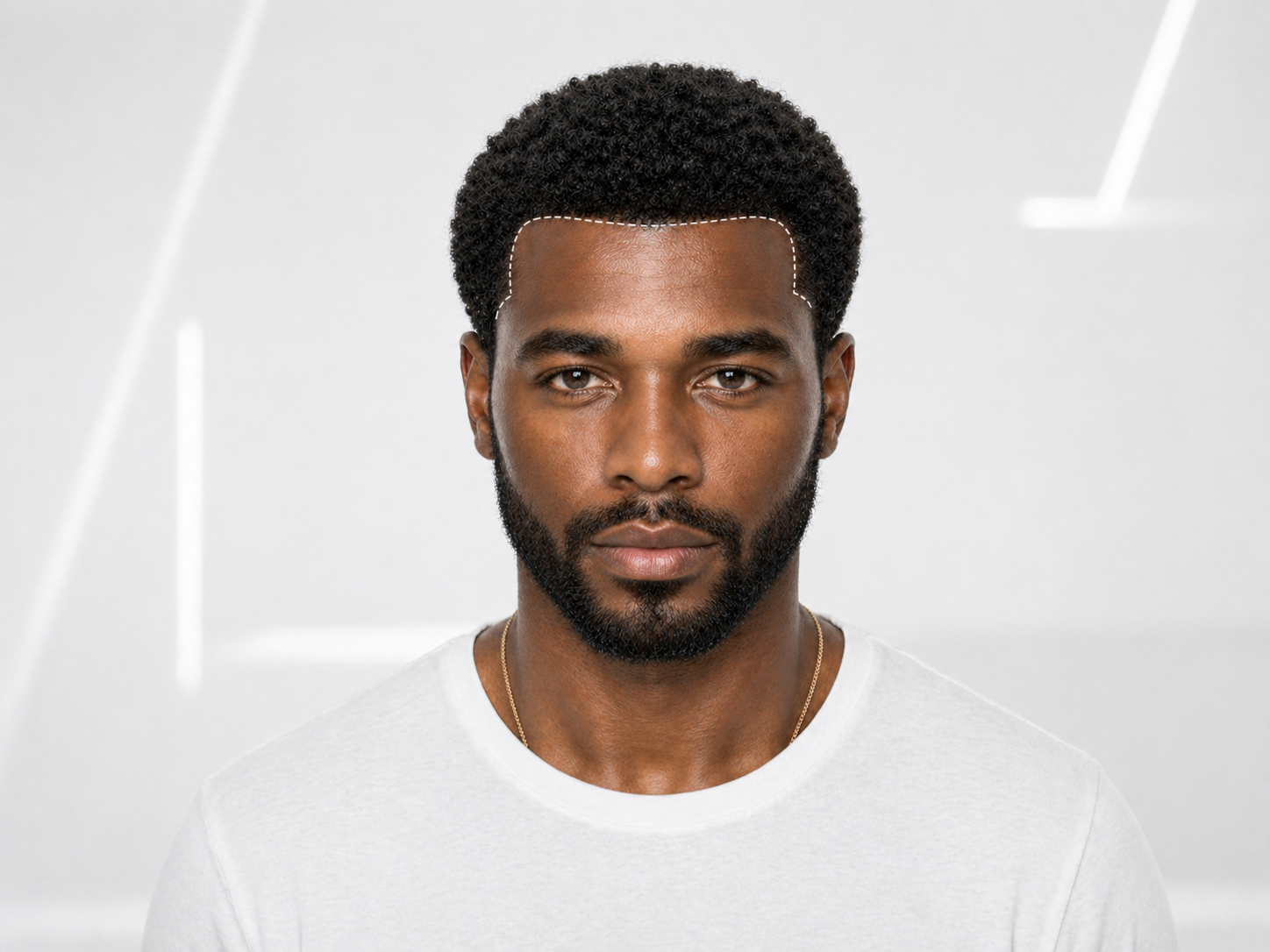 Afro Hair Transplant