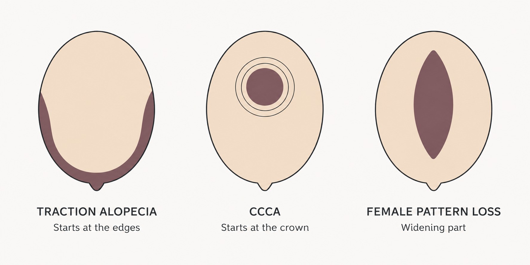 Black Female Hair Transplant: What the Diagnosis Decides 2 Where hair loss begins in Black women: traction alopecia at the hairline edges, CCCA at the crown spreading outward, female pattern loss widening the central part