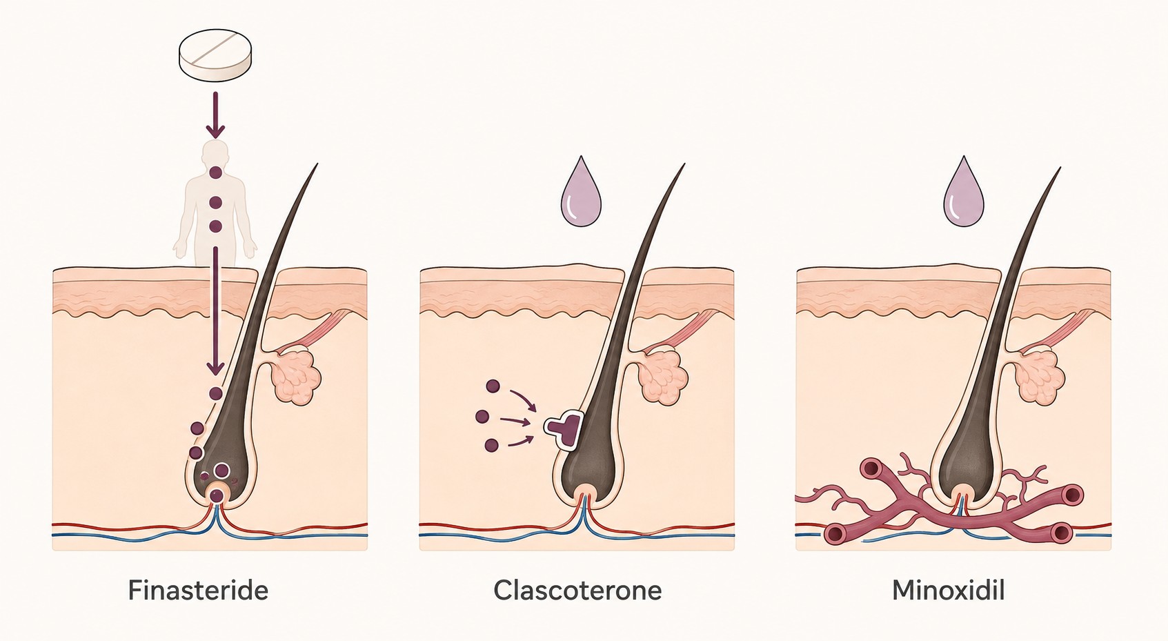 Clascoterone Türkiye: Breezula %5 Satın Alınabilir mi? 2 Saç dökülmesi tedavilerinin mekanizma karşılaştırması: finasterid DHT üretimini sistemik olarak azaltır, clascoterone androjen reseptörünü lokal olarak bloke eder, minoksidil farklı bir yoldan etki eder