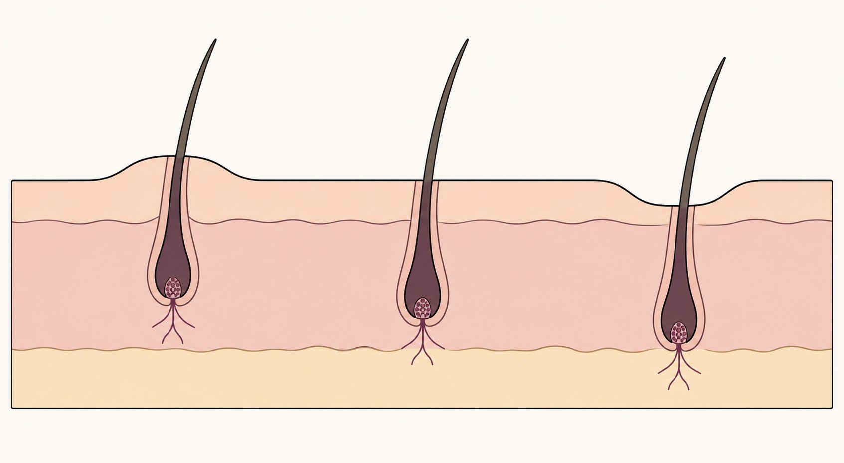 Cobblestoning After a Hair Transplant: Cause, Timeline and Correction 3 Cross-section of graft placement depth: a graft placed too high causes cobblestoning, a flush graft heals level, and a graft placed too deep causes pitting