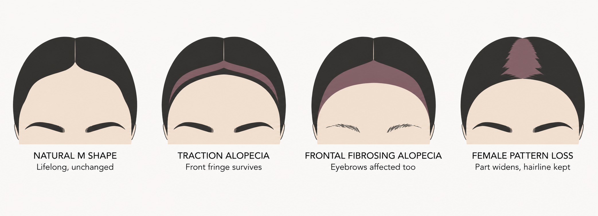 M-Shaped Hairline in Women: Natural, or Something Changing? 2 Four hairline patterns in women: a natural M shape, traction alopecia with a surviving front fringe, frontal fibrosing alopecia with eyebrow loss, and female pattern loss widening the part