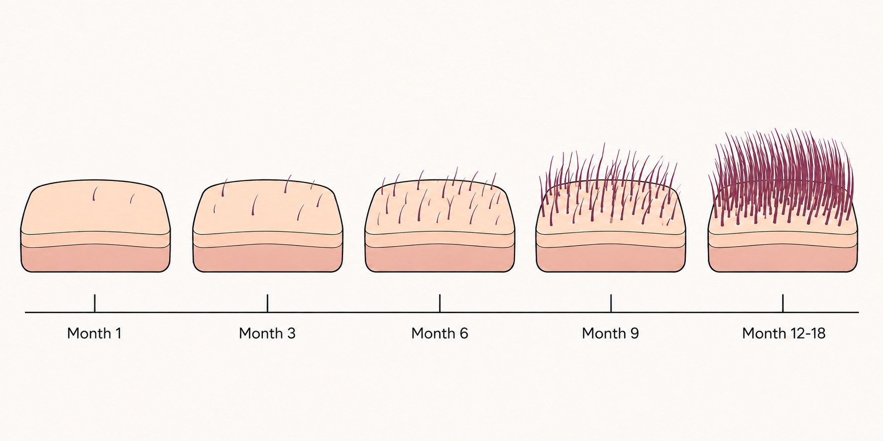 Hair Transplant After 3 Months: What Is Normal and What Is Not 3 Hair transplant growth from month 1 to month 18, showing month 3 as the earliest stage at which new hair begins to appear
