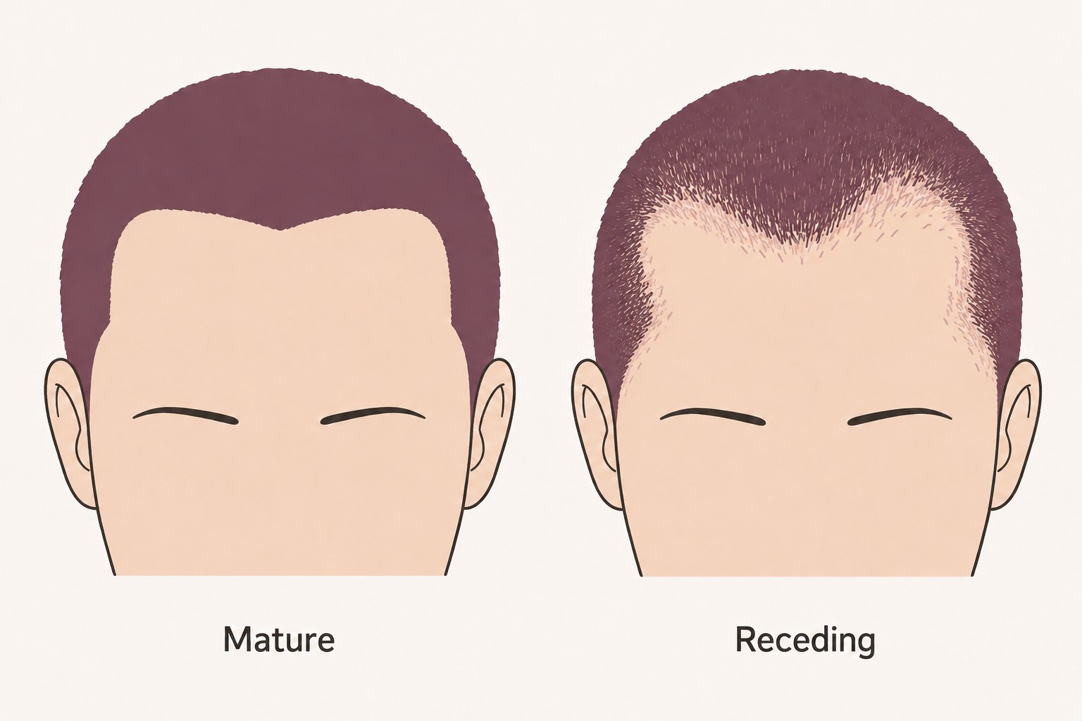 Mature Hairline vs Receding Hairline: How to Tell the Difference 2 A mature hairline with a sharp, full edge next to a receding hairline with deeper uneven notches and a soft, thinning edge
