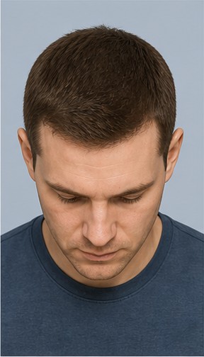 Norwood Scale Explained: Hair Loss Stages 1–7 2 Norwood stage 1 hair loss pattern: full adolescent hairline with no visible recession