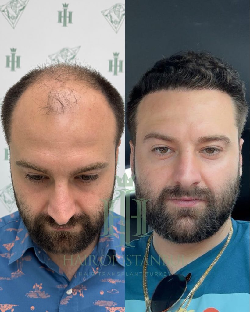 Hair transplant result, 4,450 grafts, Before & After — Hair of Istanbul