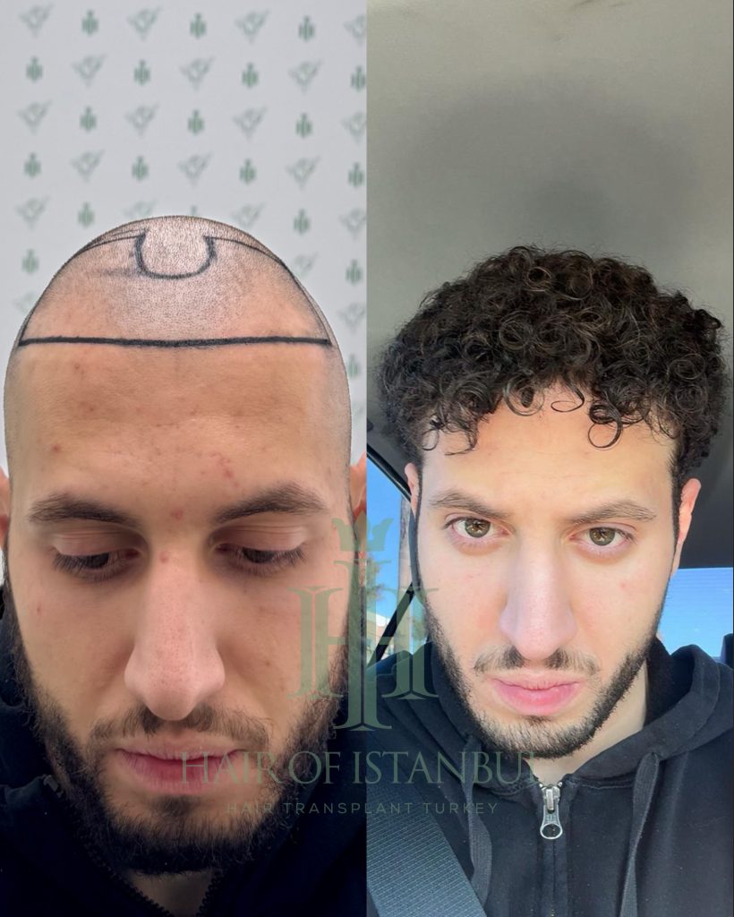 Hair transplant result, 4,500 grafts, Before & After — Hair of Istanbul