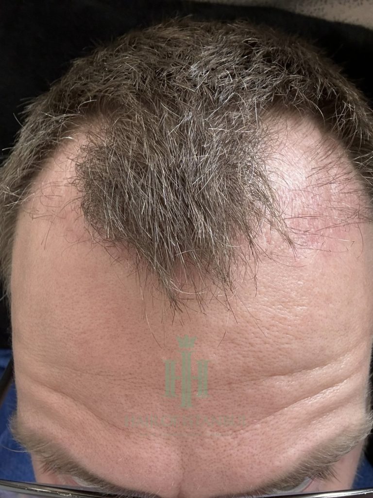Hair transplant result, 2,700 grafts, Month 1 — Hair of Istanbul