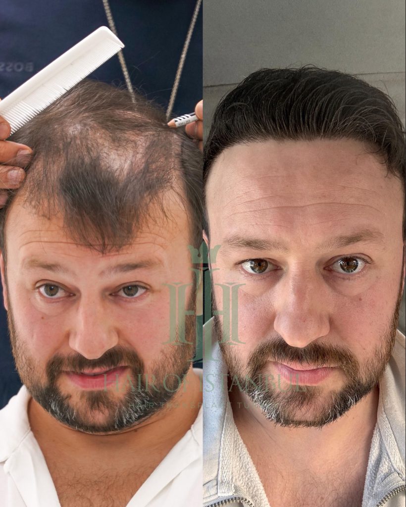 Hair transplant result, 4,300 grafts, Before & After — Hair of Istanbul