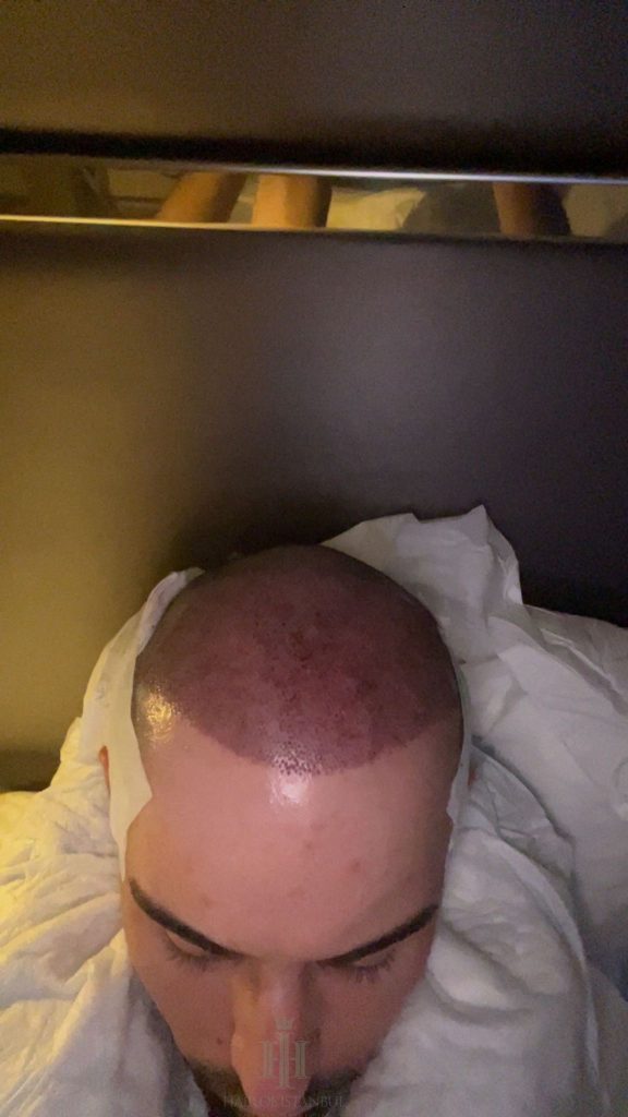 Hair transplant result, 3,100 grafts, Before & After (2) — Hair of Istanbul