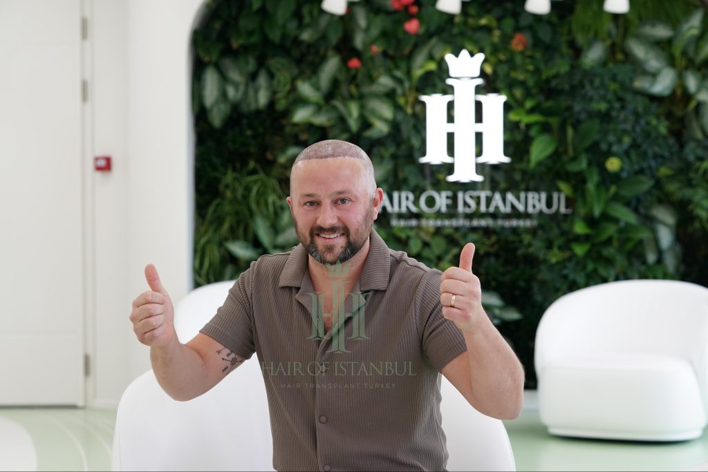 Hair transplant result, 4,300 grafts, Day 1 — Hair of Istanbul