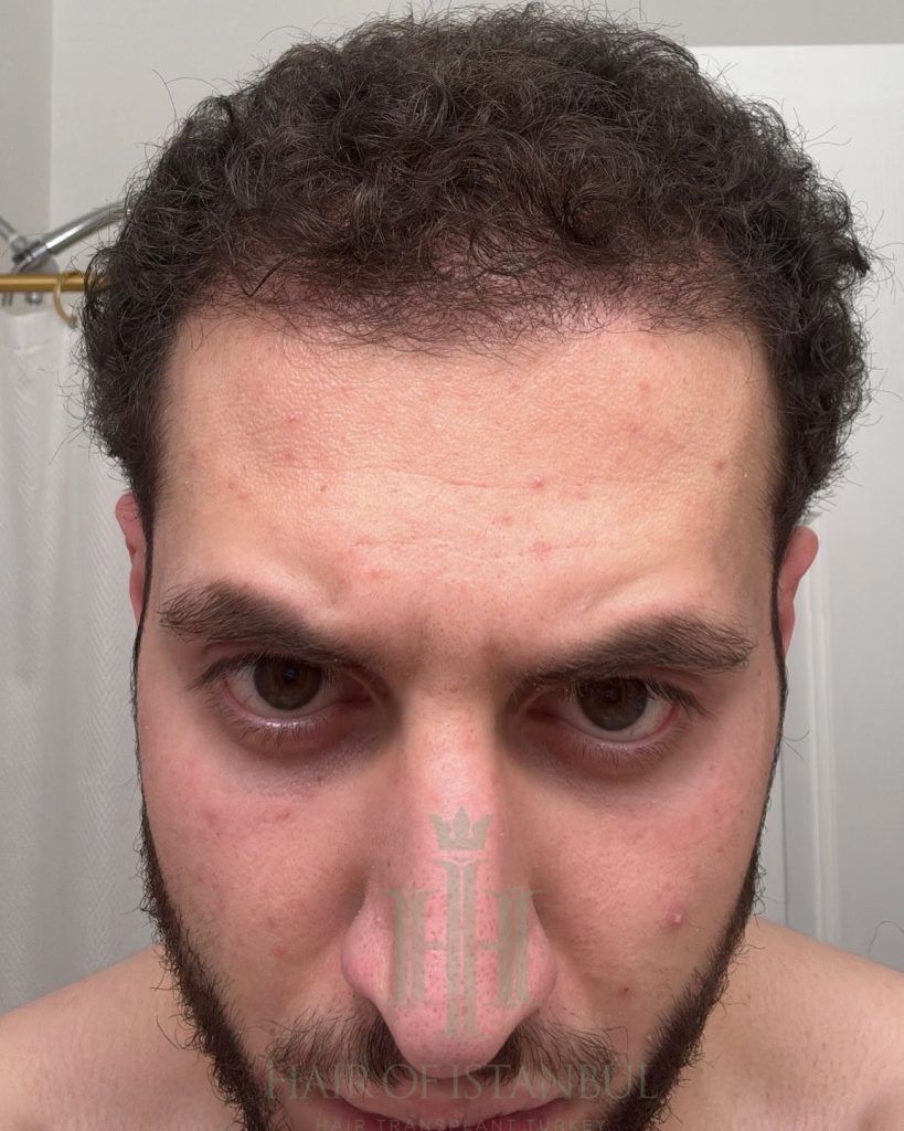 Hair transplant result, 4,500 grafts, Month 4 — Hair of Istanbul