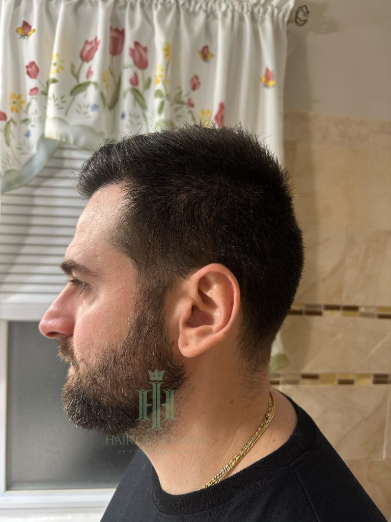 Hair transplant result, 4,450 grafts, Month 7 — Hair of Istanbul