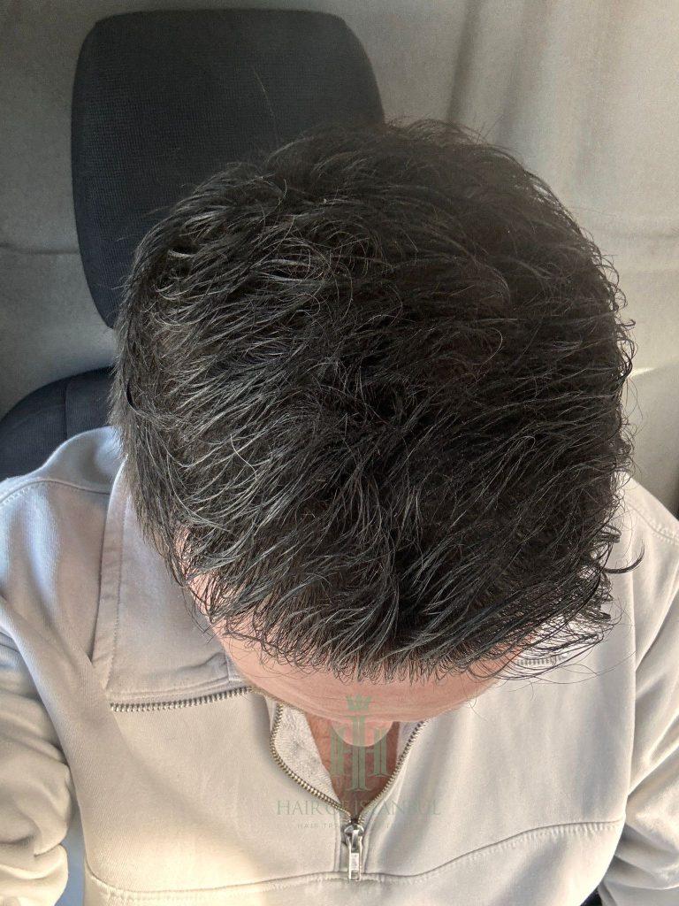 Hair transplant result, 4,300 grafts, Month 11 — Hair of Istanbul