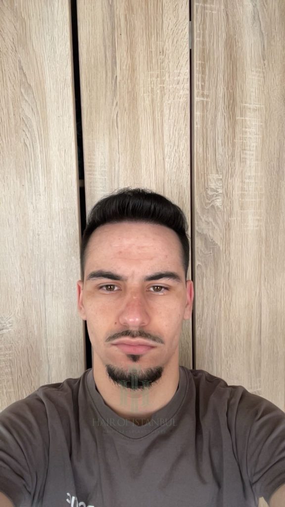 Hair transplant result, 3,100 grafts, Before & After (4) — Hair of Istanbul