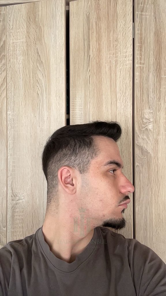 Hair transplant result, 3,100 grafts, Before & After (3) — Hair of Istanbul