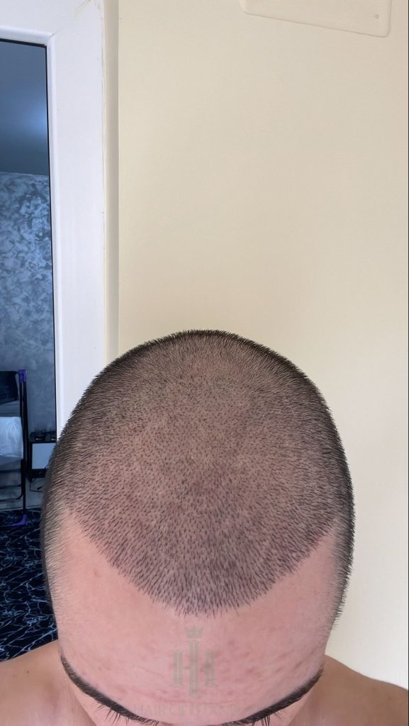 Hair transplant result, 3,100 grafts, Day 10 — Hair of Istanbul