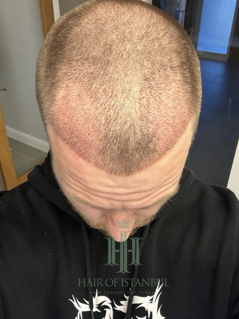 Hair transplant result, 2,700 grafts, Day 10 — Hair of Istanbul