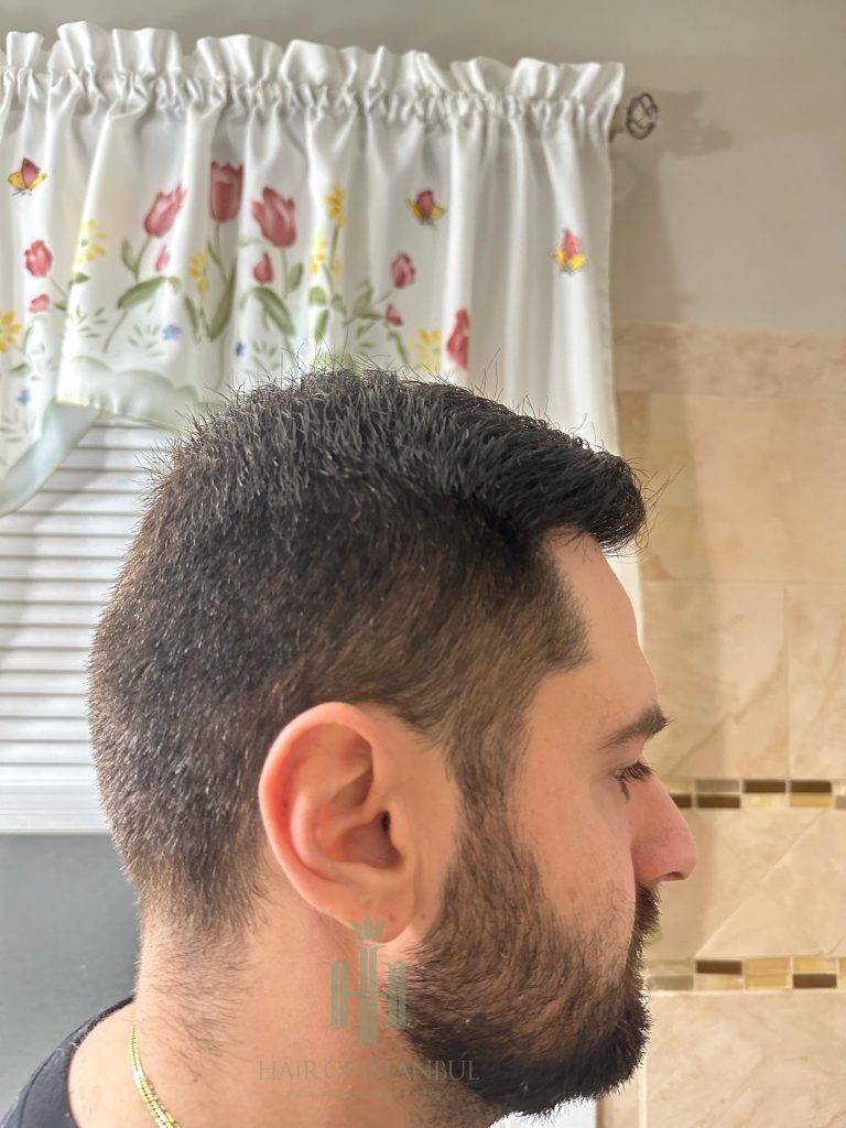 Hair transplant result, 4,450 grafts, Month 7 (2) — Hair of Istanbul