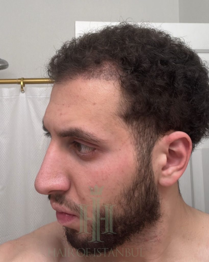 Hair transplant result, 4,500 grafts, Month 4 (2) — Hair of Istanbul