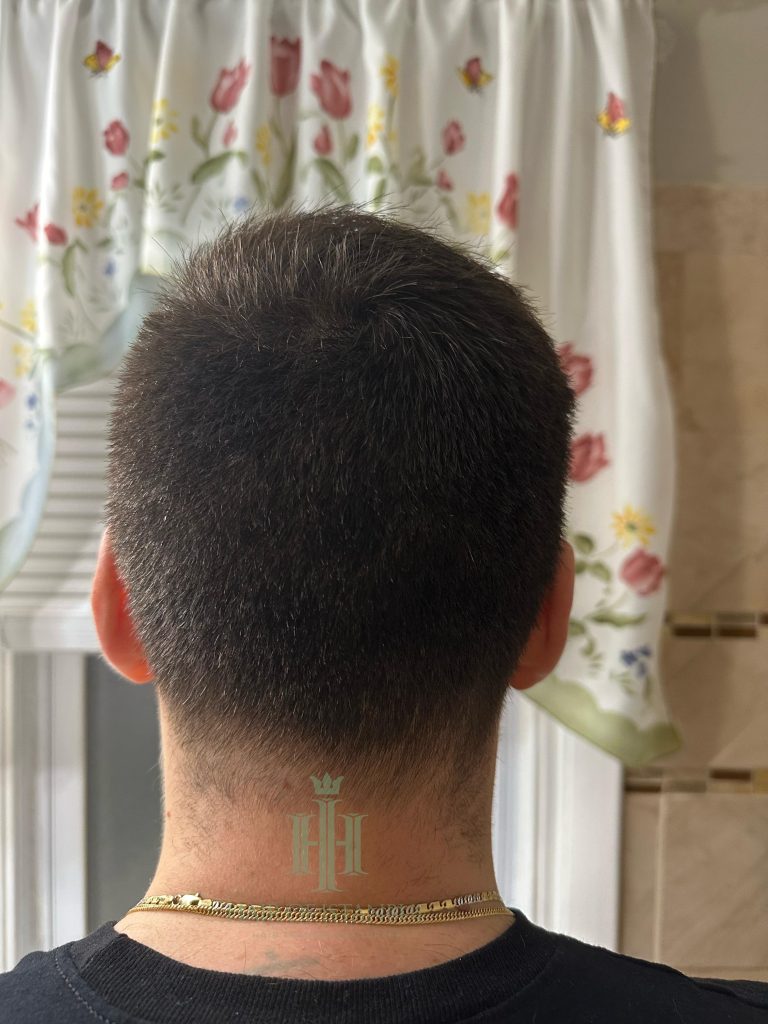Hair transplant result, 4,450 grafts, Donor area — Hair of Istanbul
