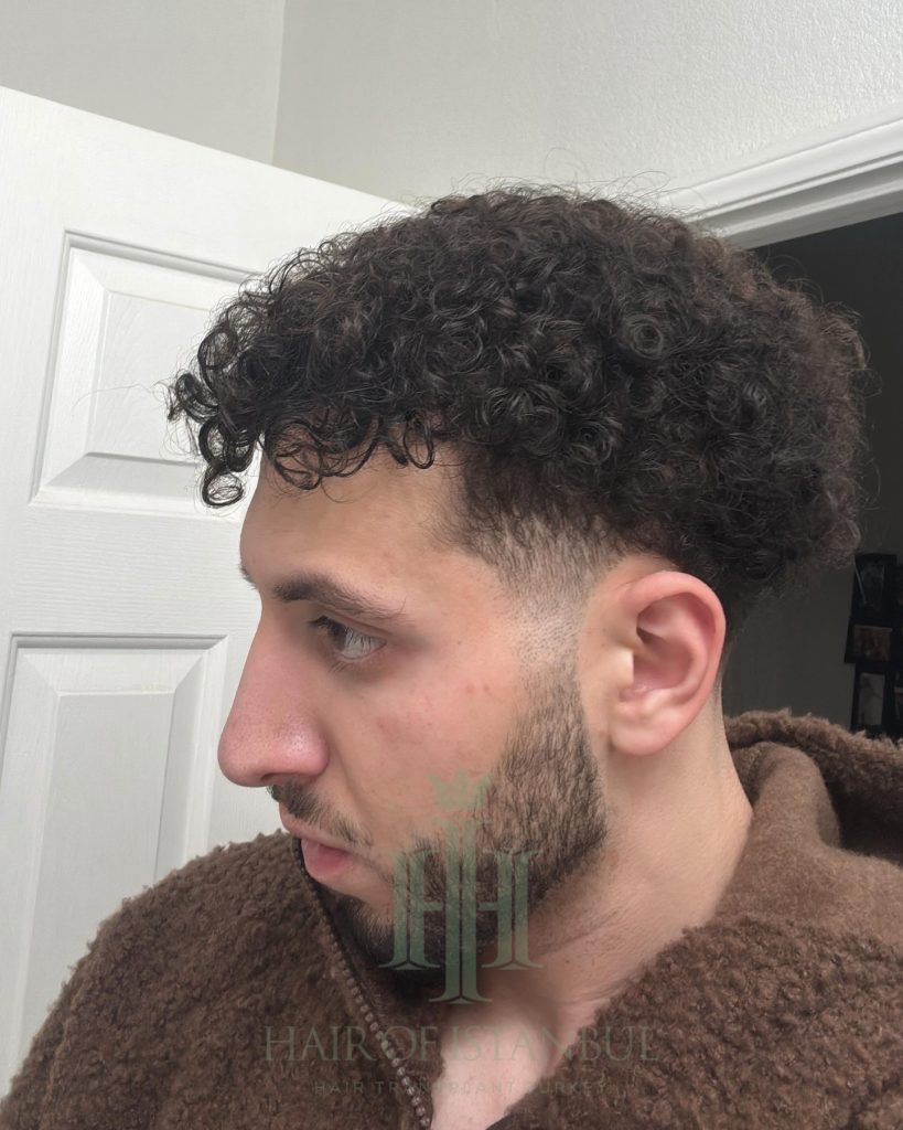 Hair transplant result, 4,500 grafts, Month 12 — Hair of Istanbul
