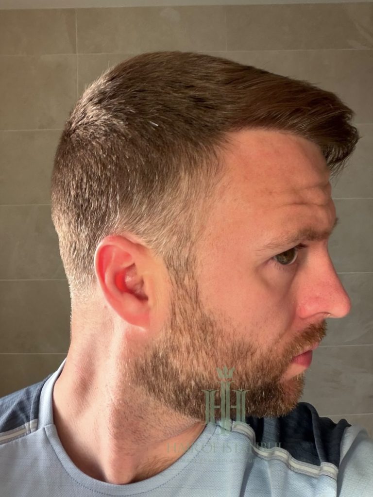 Hair transplant result, 2,700 grafts, Month 12 (2) — Hair of Istanbul
