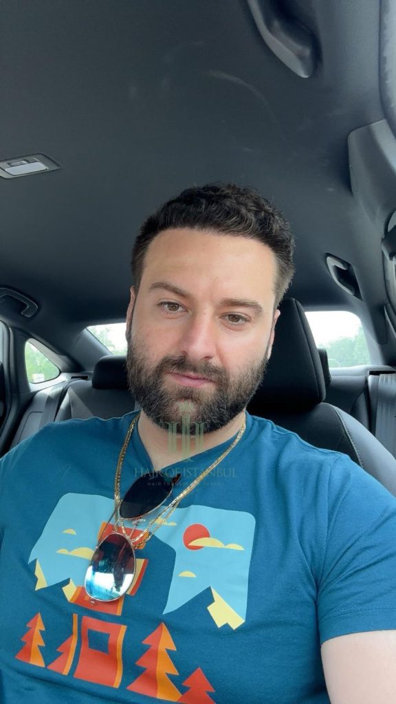 Hair transplant result, 4,450 grafts, Month 12 — Hair of Istanbul