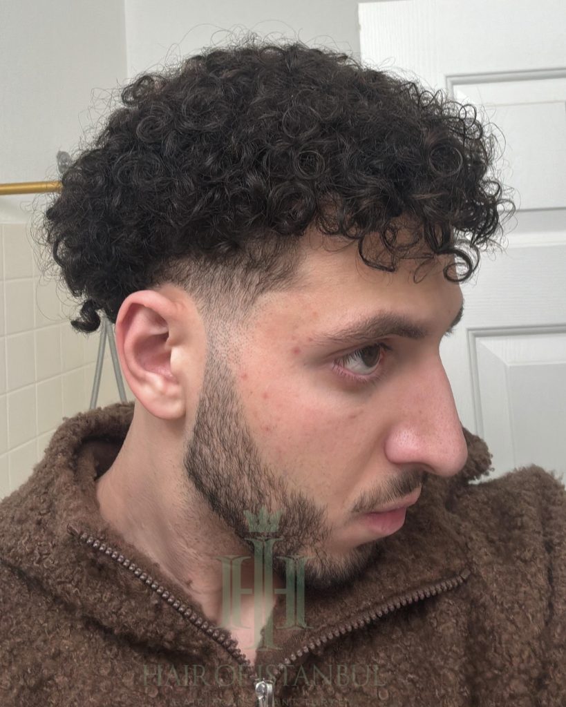 Hair transplant result, 4,500 grafts, Month 12 (2) — Hair of Istanbul