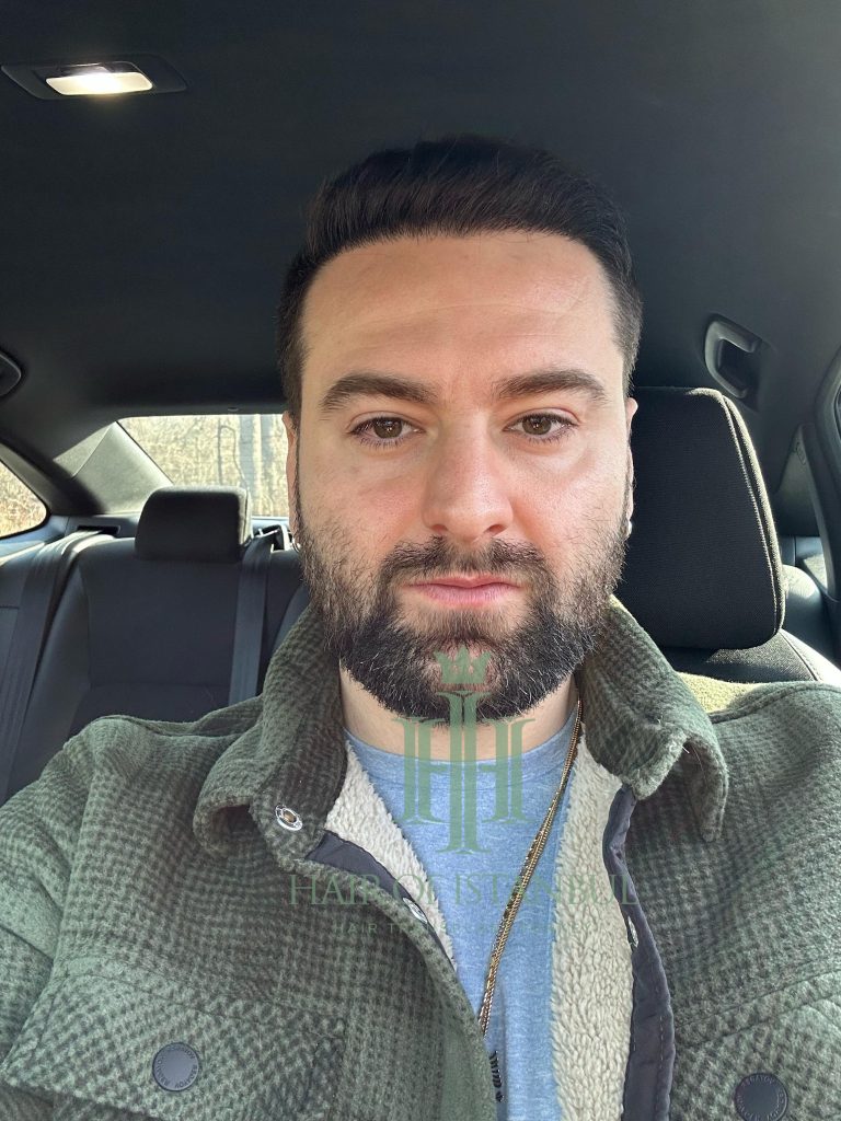 Hair transplant result, 4,450 grafts, Month 12 (2) — Hair of Istanbul