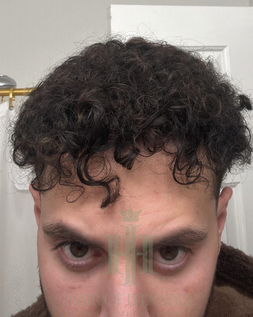 Hair transplant result, 4,500 grafts, Month 12 (3) — Hair of Istanbul