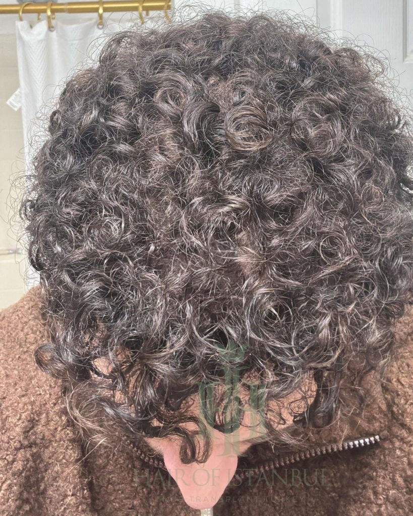 Hair transplant result, 4,500 grafts, Month 12 (4) — Hair of Istanbul