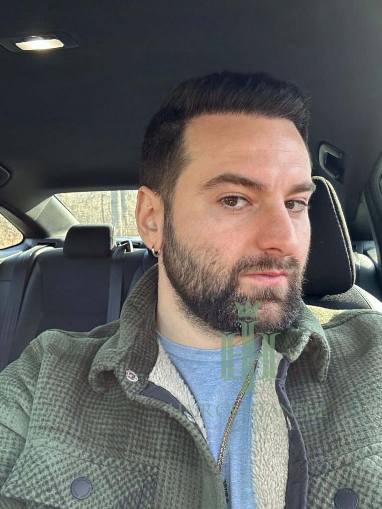 Hair transplant result, 4,450 grafts, Month 12 (3) — Hair of Istanbul