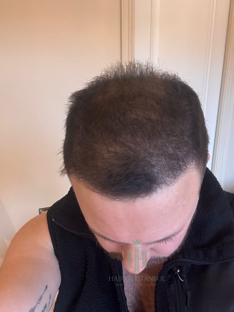 Hair transplant result, 4,300 grafts, Month 5 — Hair of Istanbul