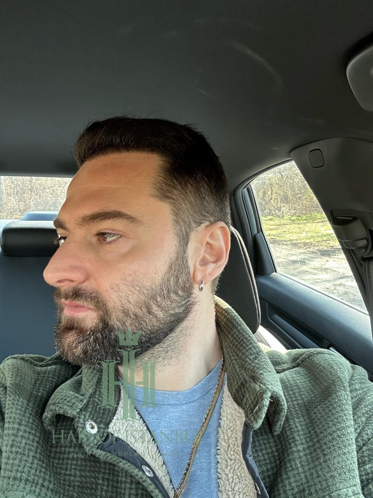 Hair transplant result, 4,450 grafts, Month 12 (4) — Hair of Istanbul