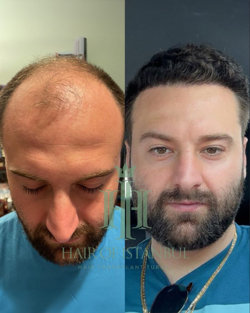 Hair transplant result, 4,450 grafts, Before & After (2) — Hair of Istanbul
