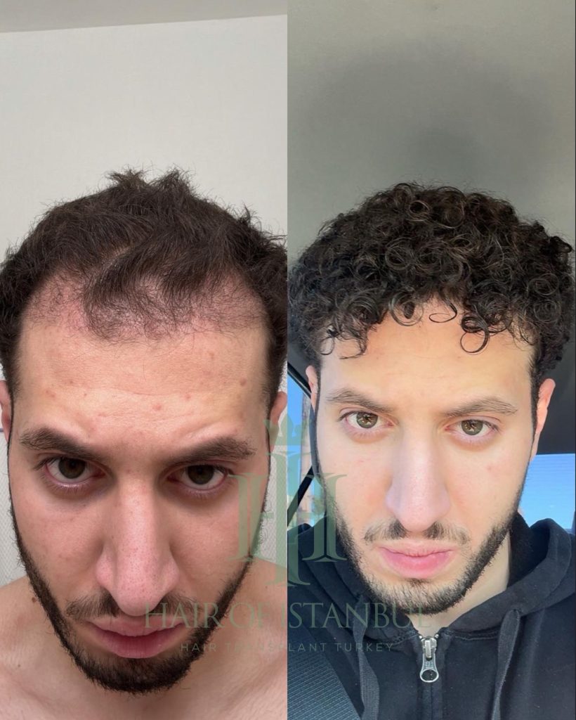 Hair transplant result, 4,500 grafts, Before & After (2) — Hair of Istanbul