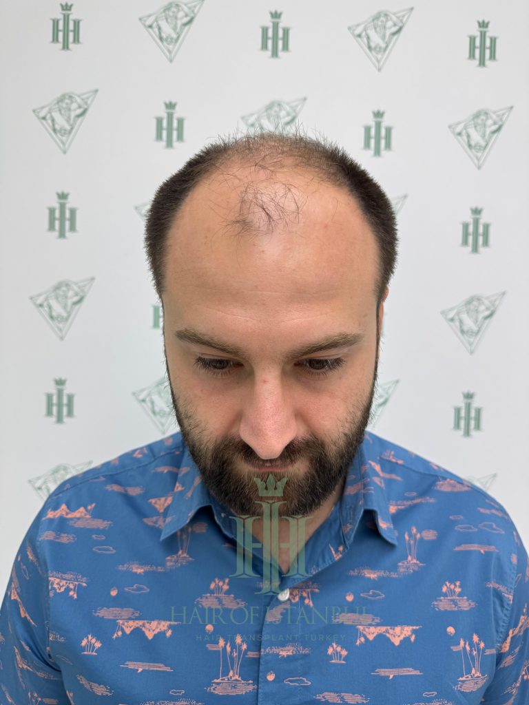Hair transplant result, 4,450 grafts, Before — Hair of Istanbul