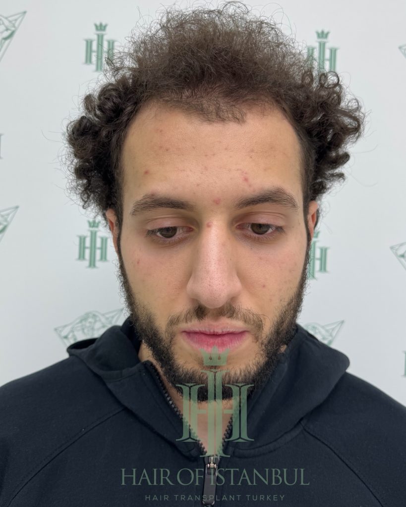 Hair transplant result, 4,500 grafts, Before — Hair of Istanbul