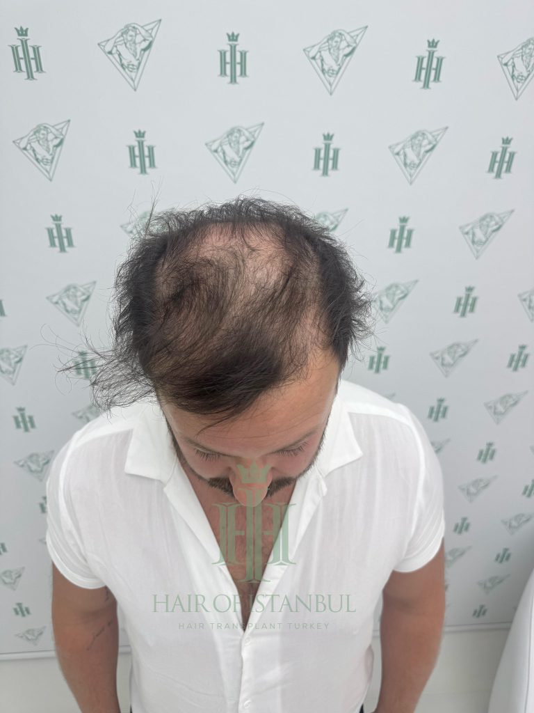 Hair transplant result, 4,300 grafts, Before — Hair of Istanbul