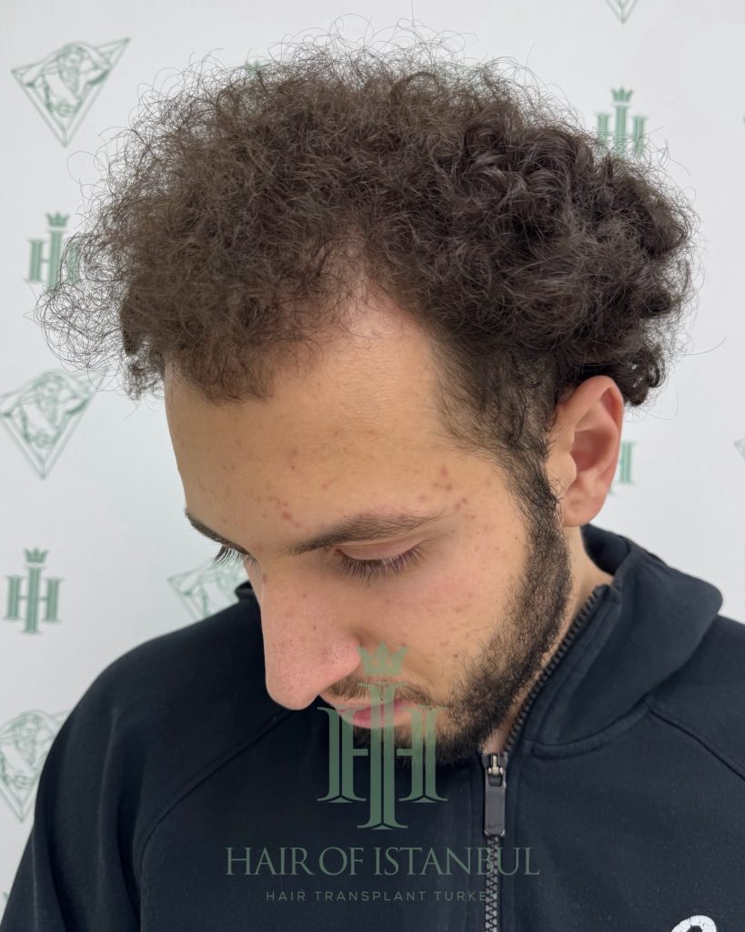 Hair transplant result, 4,500 grafts, Before (2) — Hair of Istanbul