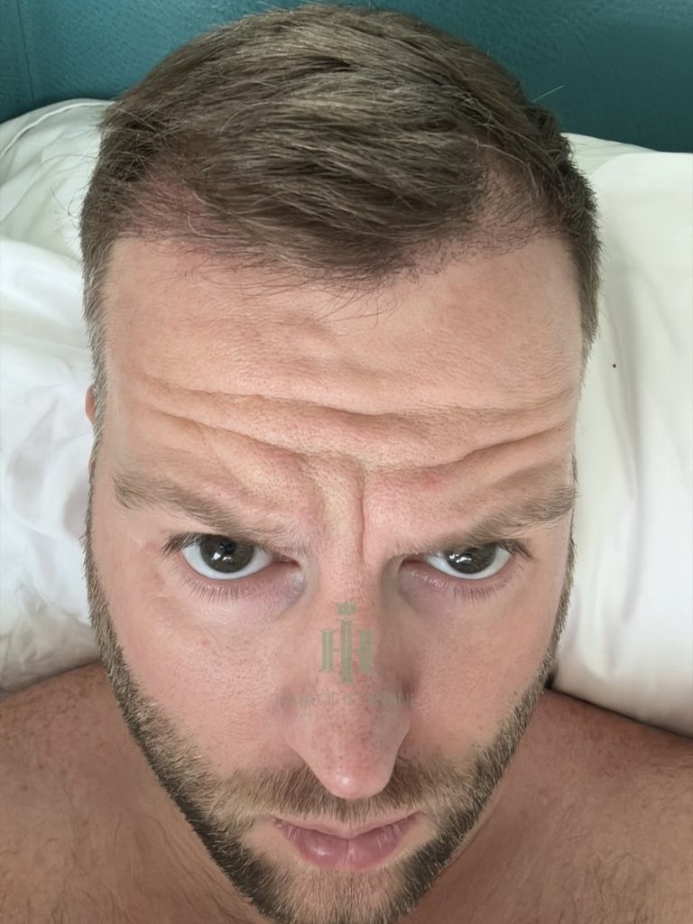 Hair transplant result, 2,700 grafts, Month 3 — Hair of Istanbul