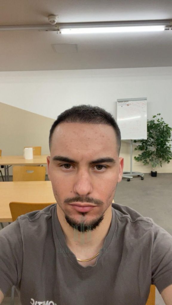 Hair transplant result, 3,100 grafts, Month 3 (2) — Hair of Istanbul