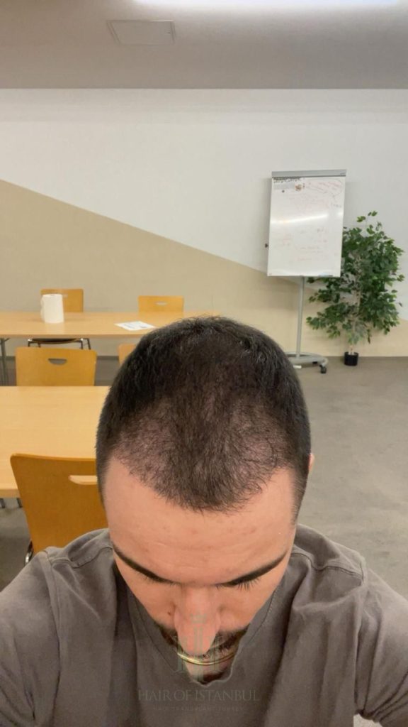 Hair transplant result, 3,100 grafts, Month 3 — Hair of Istanbul