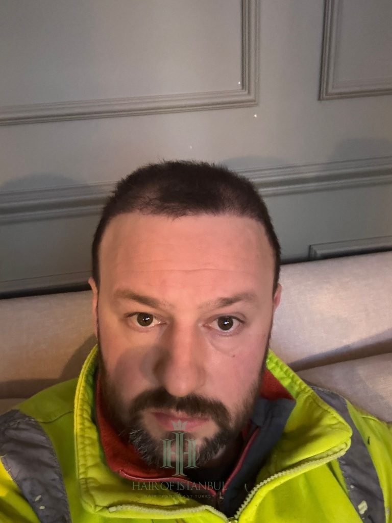 Hair transplant result, 4,300 grafts, Month 3 — Hair of Istanbul