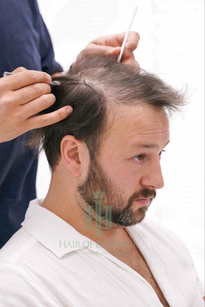 Hair transplant result, 4,300 grafts, Before (2) — Hair of Istanbul