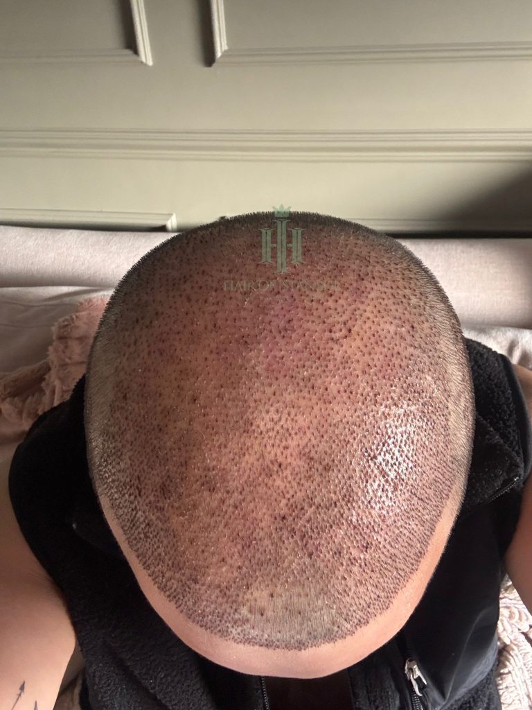 Hair transplant result, 4,300 grafts, Day 3 — Hair of Istanbul