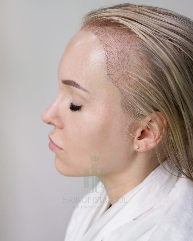 Women’s hair transplant result, 2,000 grafts, Day 3 — Hair of Istanbul