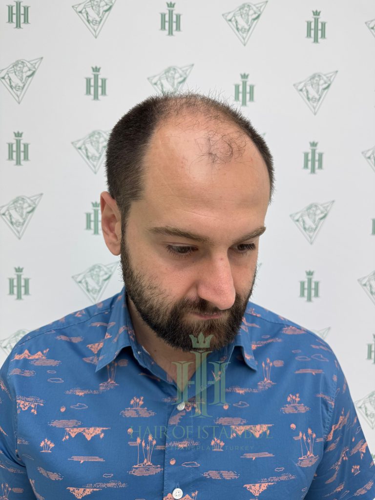Hair transplant result, 4,450 grafts, Before (3) — Hair of Istanbul