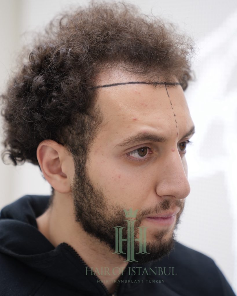Hair transplant result, 4,500 grafts, Before (3) — Hair of Istanbul